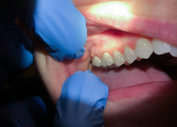 Best Emergency Wisdom Teeth Removal in Stateburg, SC